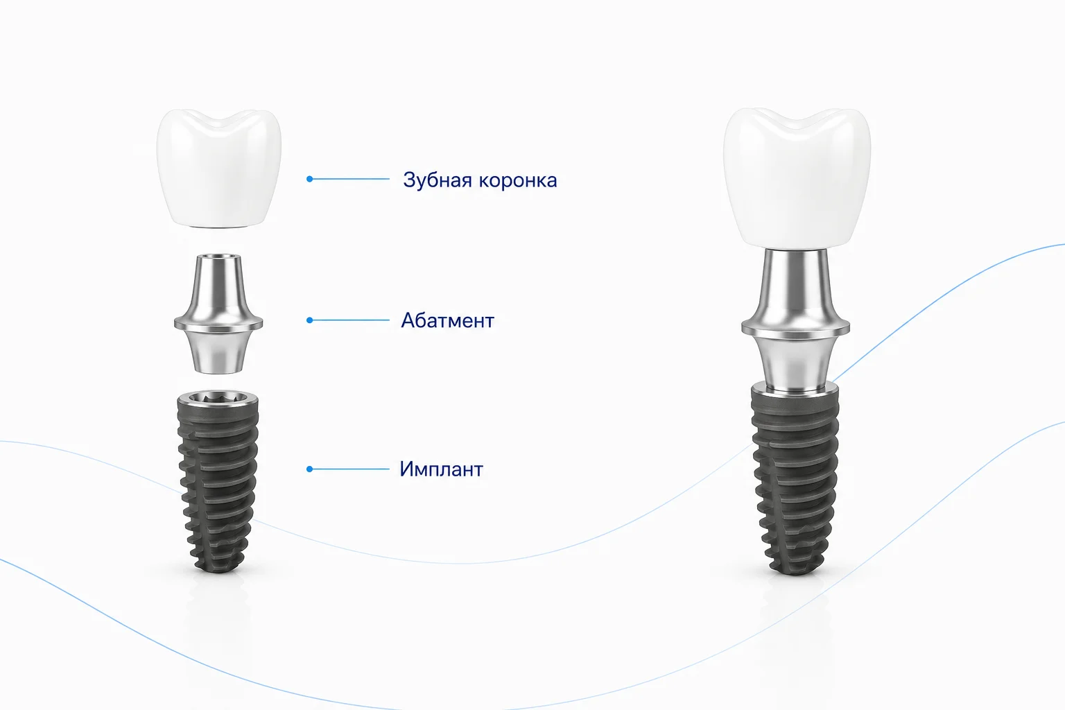 имплант neodent